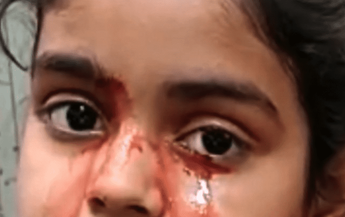 VIRAL: Niña de la India llora lágrimas de sangre y conmociona al mundo entero | PalabrasClaras.mx