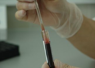 La sangre en la orina, el síntoma principal del cáncer de vejiga