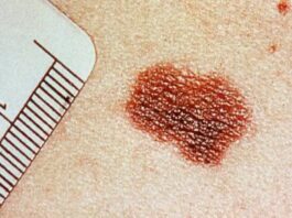 Melanoma, claves de un cáncer con una vacuna en el horizonte