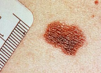 Melanoma, claves de un cáncer con una vacuna en el horizonte