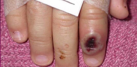 Guía sobre mpox: síntomas, transmisión y tratamiento